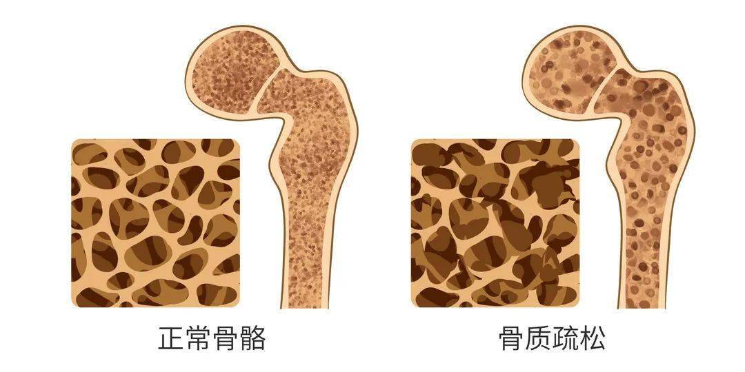 天天补钙,还得骨质疏松?这8个坏习惯,很多人天天在做