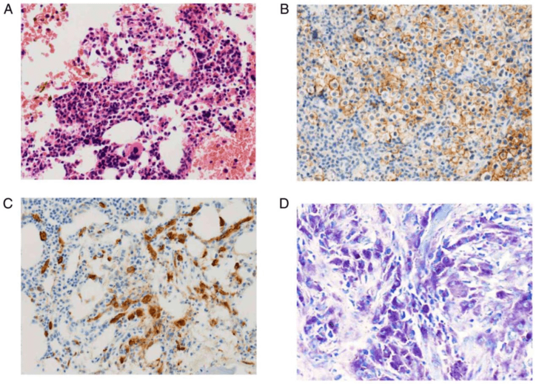 是相当罕见的 系统性肥大细胞增多症(systemic mastocytosis