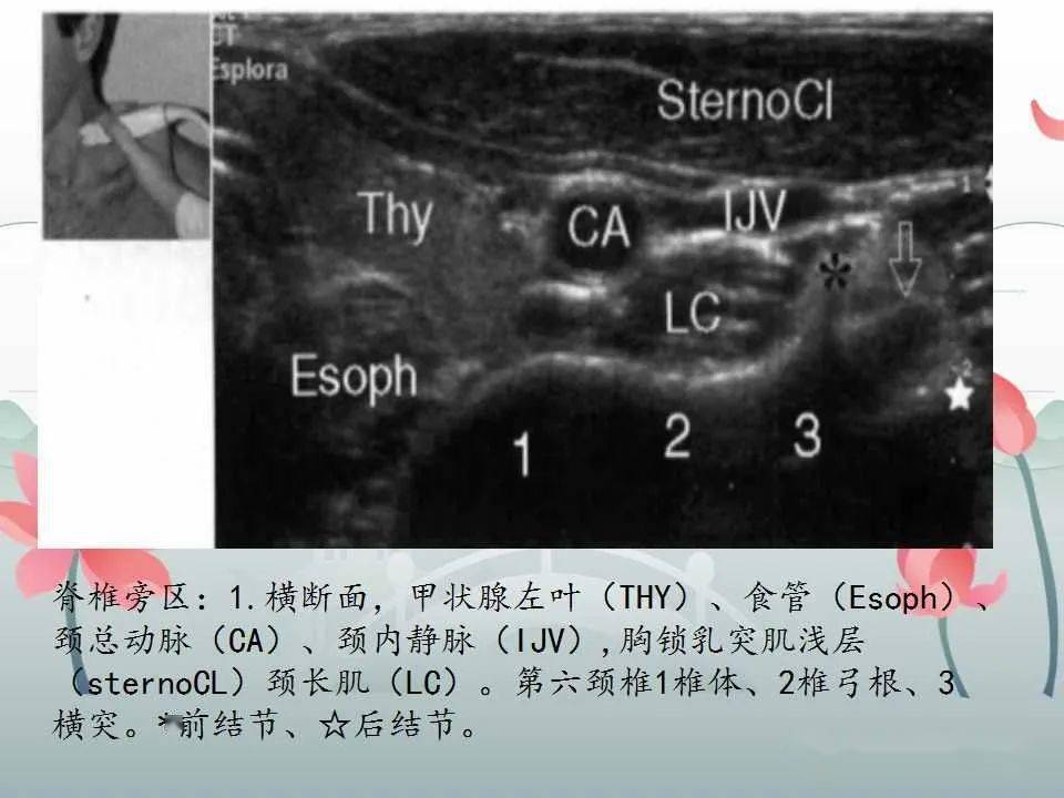 文献阅读与病例讨论61臂丛神经的解剖与超声扫查_李清泉