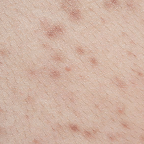皮疹多形性,瘙痒剧烈,急性期以丘疱疹为主,有渗出倾向,慢性期以苔藓样