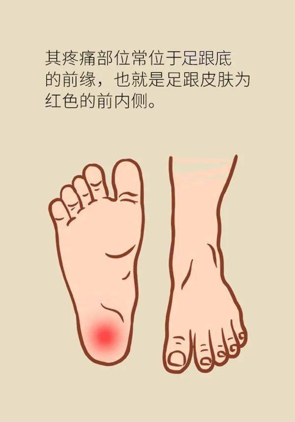 跑完步后脚后跟疼?可能是这6种原因导致的!