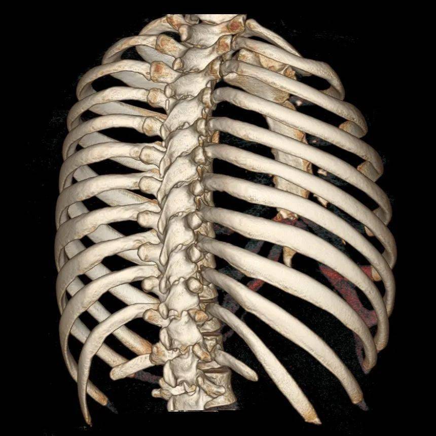因此,多层螺旋ct扫描及三维重建成像在诊断肋骨骨折方面比胸片具有