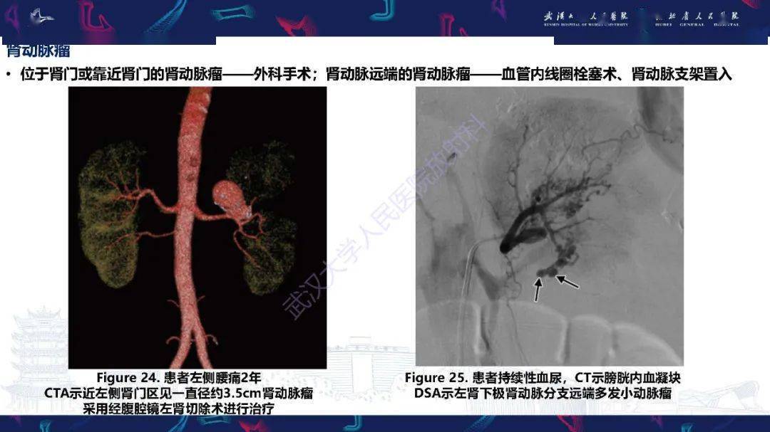 肾动脉:解剖,病理及血管内治疗