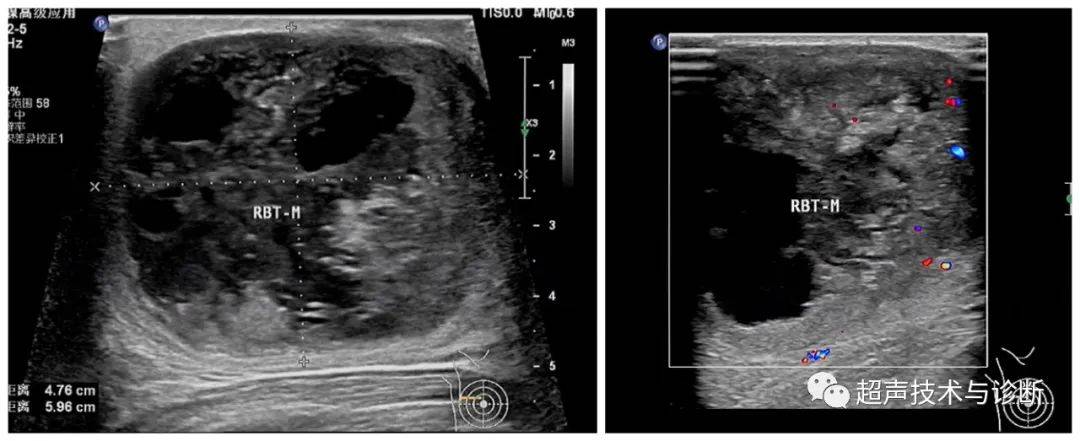 乳腺叶状肿瘤的超声表现