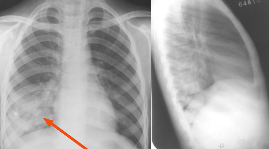 胸片如何看肺炎这篇文章帮你立刻入门
