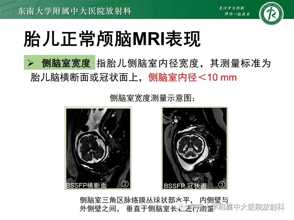 mri平扫外院b超示:胎儿侧脑室扩张,小脑结构模糊胎儿唐筛:低风险女