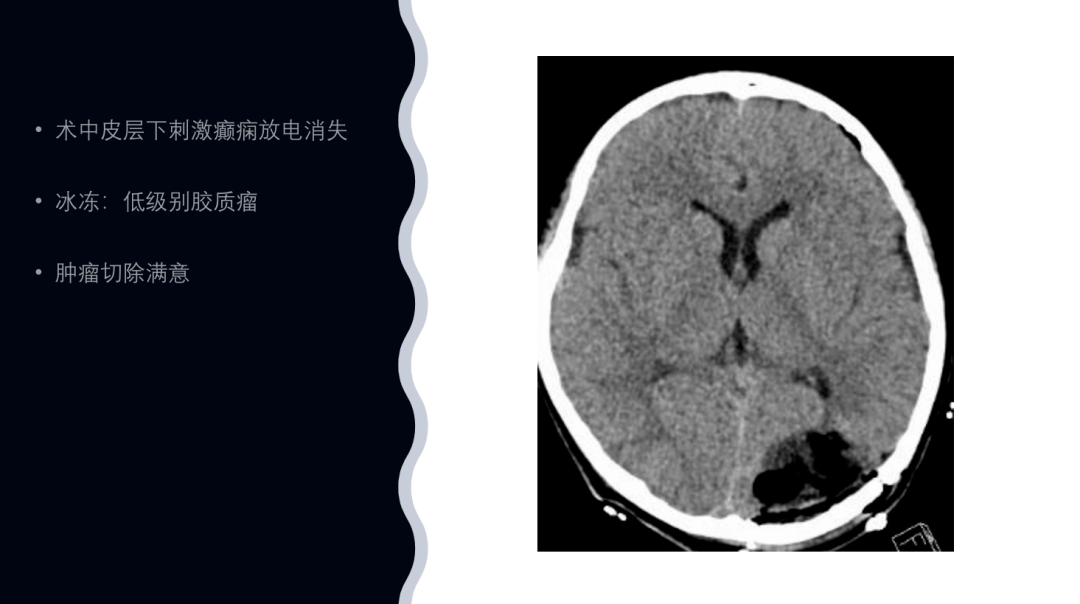 岛叶胶质瘤一例我们是伞兵注定要被包围