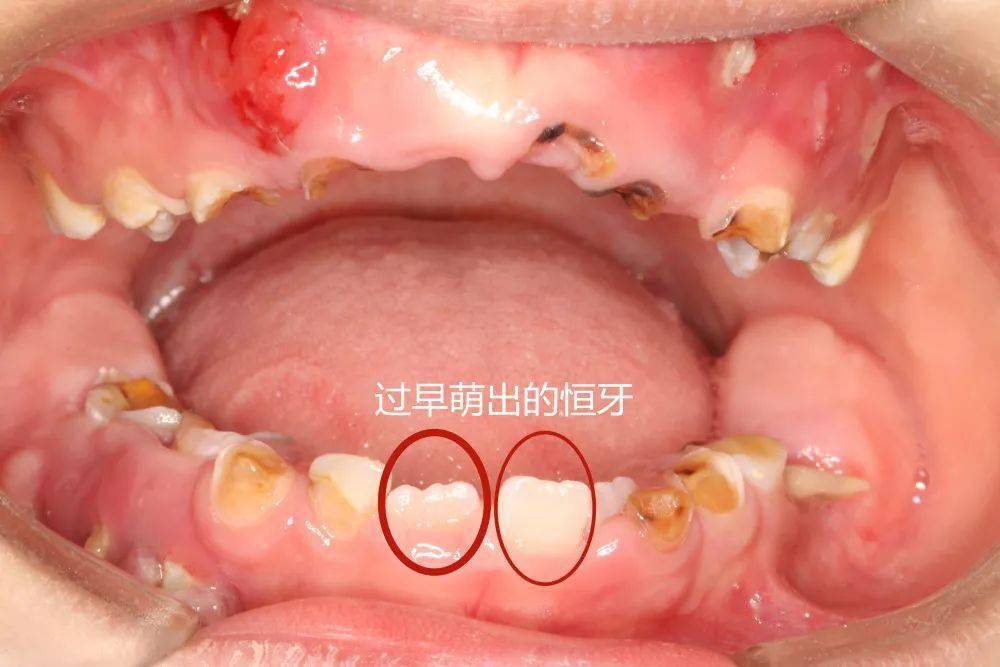 同时,瑞瑞下门牙有2颗乳牙因龋坏严重而过早缺失,导致恒牙过早萌出