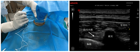 超声引导下胸椎旁神经阻滞