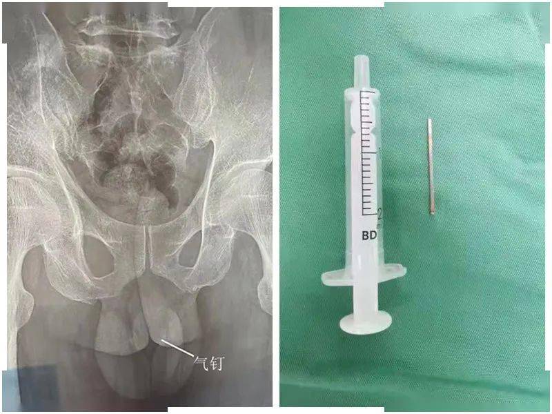 阴囊睾丸损伤及取出的气钉