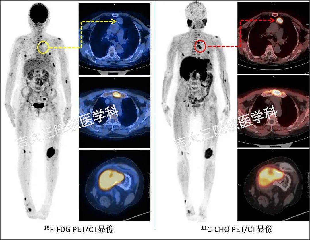 【发布】吉大三院 | c-cho pet/ct显像诊断异位甲旁亢伴棕色瘤