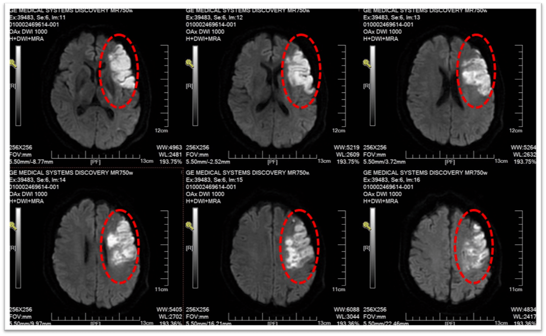 头颅dwi提示左侧额颞顶叶大面积脑梗死
