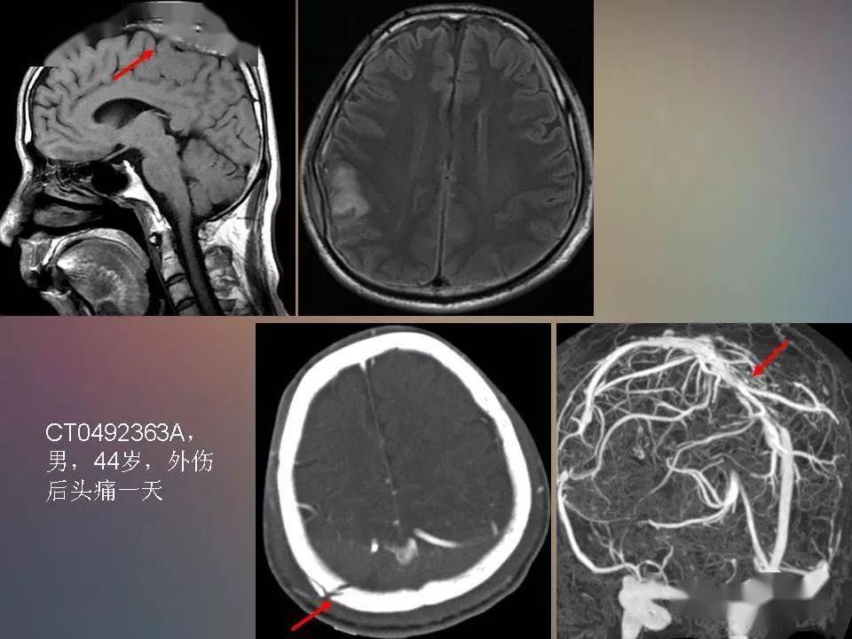 常见的急性颅脑损伤的ct和mri表现