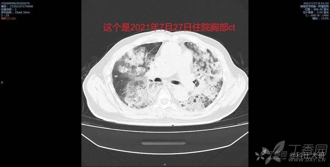 73 岁患者咳白色泡沫痰,肺部感染找不到致病菌,用药也