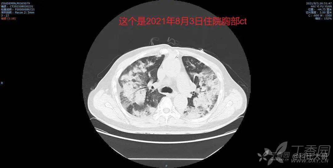 73 岁患者咳白色泡沫痰,肺部感染找不到致病菌,用药也