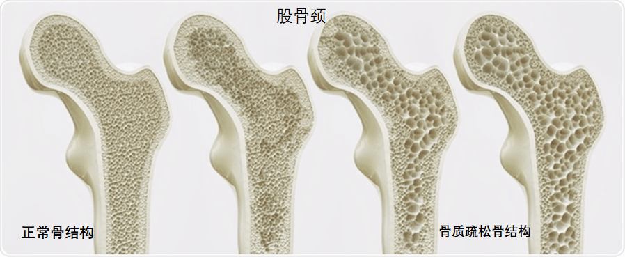 骨质疏松症是以骨量减少,骨的微观结构退化为特征的,致使骨小梁结构