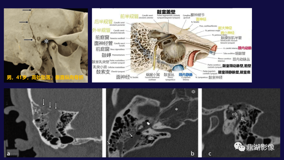 the otic capsule or osseous (bony) labyrinth:耳软骨囊或骨迷路是