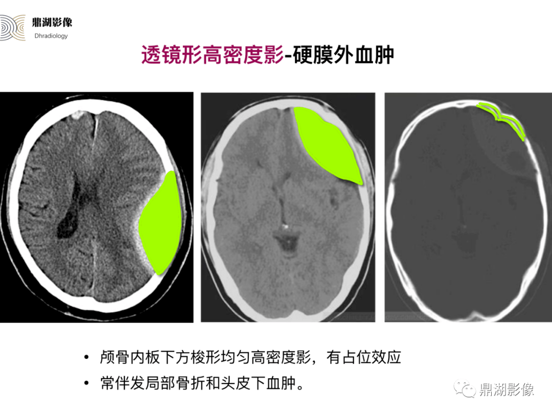 教学必备超赞ct特征性脑影像征象手绘版