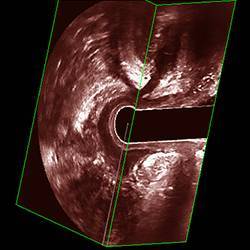 肛管|看屁股要做Ｂ超吗？细说直肠腔内超声的那些事！