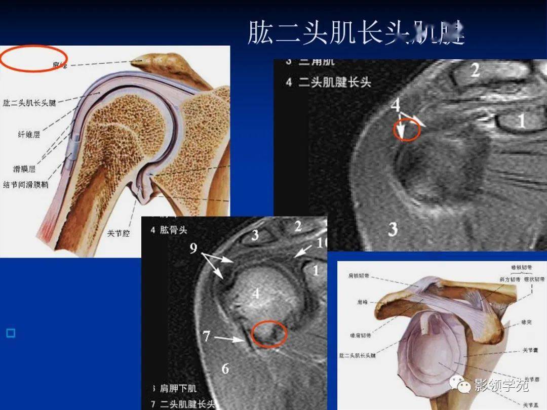 四个滑囊:肩峰下滑囊,三角肌下滑囊,喙突下滑囊,肩胛下滑囊.