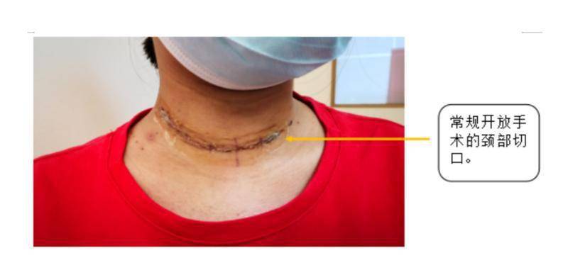 甲状腺癌手术后脖子上不留疤?医生想了这个办法