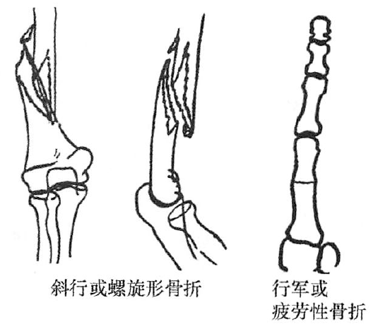 资源汇总丨急诊影像,实战病例 撕脱或劈裂骨折;螺旋形骨折 动脉瘤样