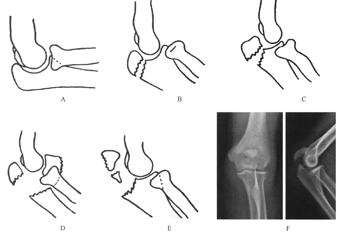 尺骨鹰嘴骨折或脱位 a.正常;b.单纯型;c.