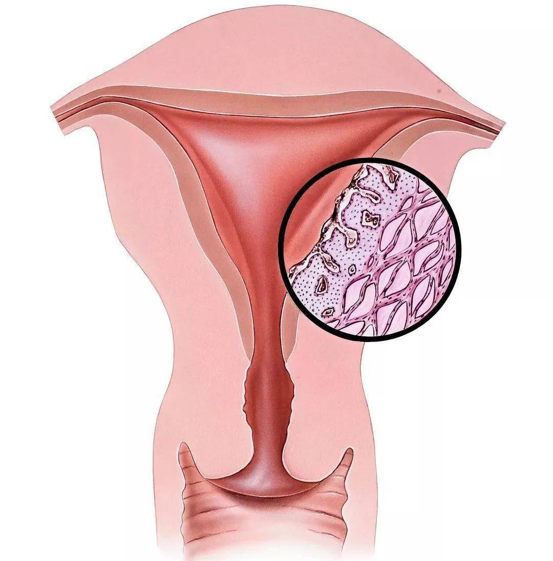 图为子宫内膜异位 cr:@视觉中国