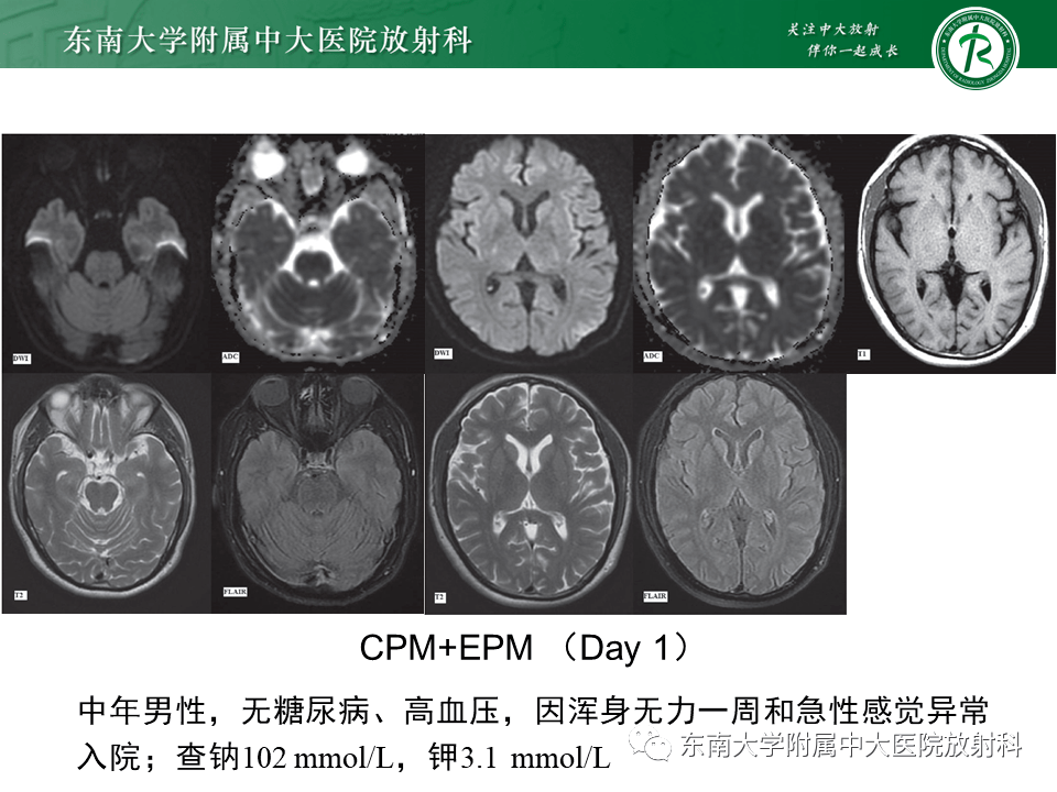 14 神经系统疾病—渗透性脱髓鞘综合征