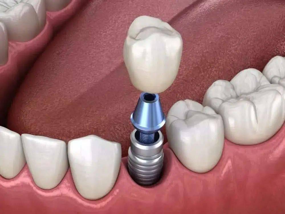 a:牙齿种植作为临床已经成熟的手术,目前已经能够达到创伤小,流血少
