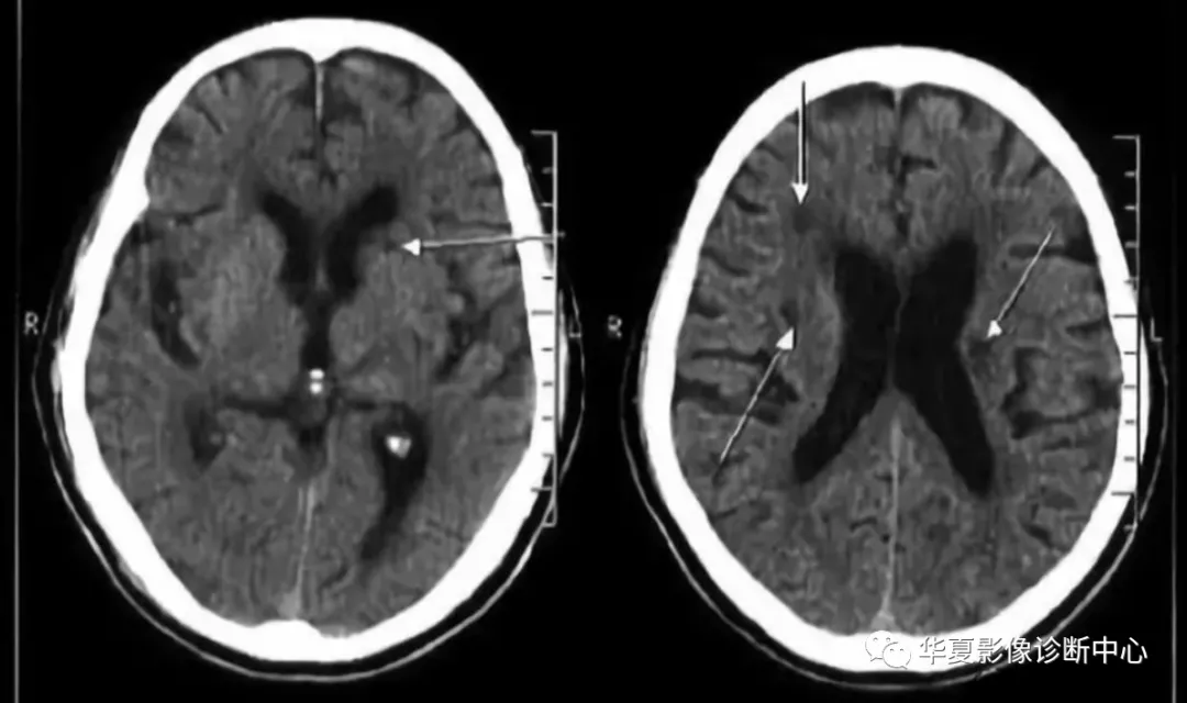 诊断腔隙性脑梗塞有三大误区,你可知道?