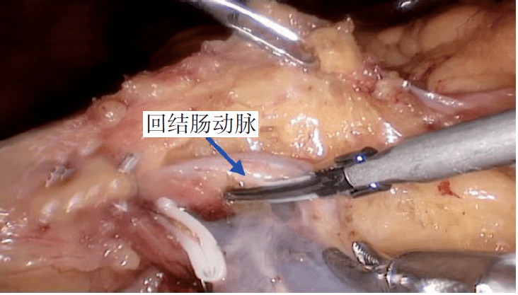 毛盛勋:腹腔镜中间 尾侧入路右半结肠癌扩大根治术|《腹腔镜胃肠手术