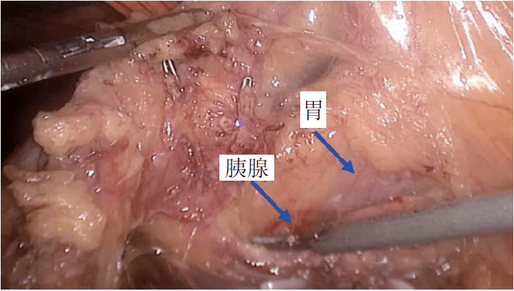 解剖横结肠中动静脉根部离断及清扫淋巴结(4)沿胰腺上缘进入胰胃