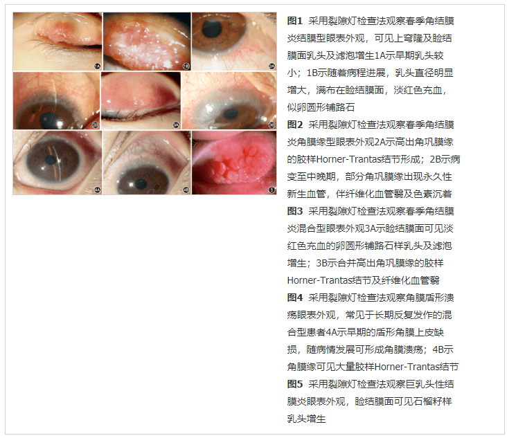 我国过敏性结膜炎诊断和治疗专家共识(2018年)