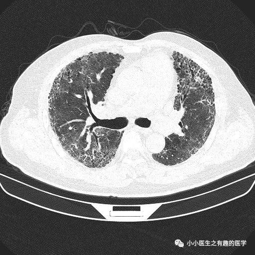 间质性肺炎的典型图谱,最全解析!