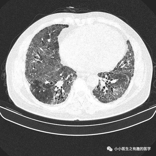 对于初学者,胸部ct胸膜下是good的,一般不是间质性肺炎