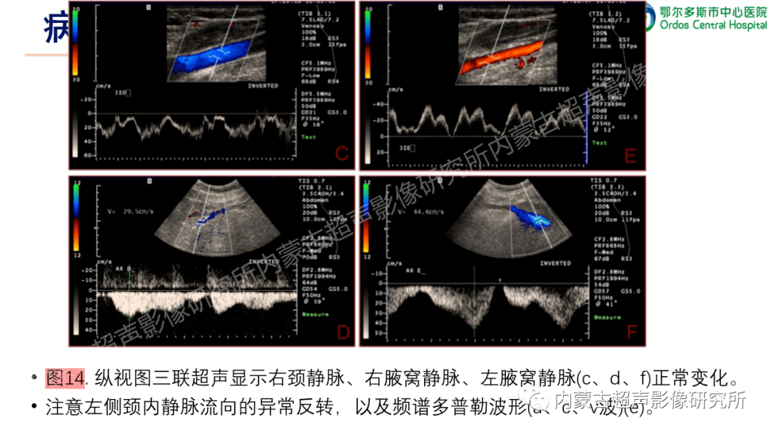 上肢深静脉血栓的超声检查.