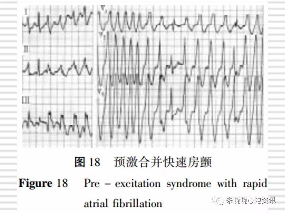 来源:朱晓晓心电资讯*文章系本平台转载,若有侵权请联系删除 推荐