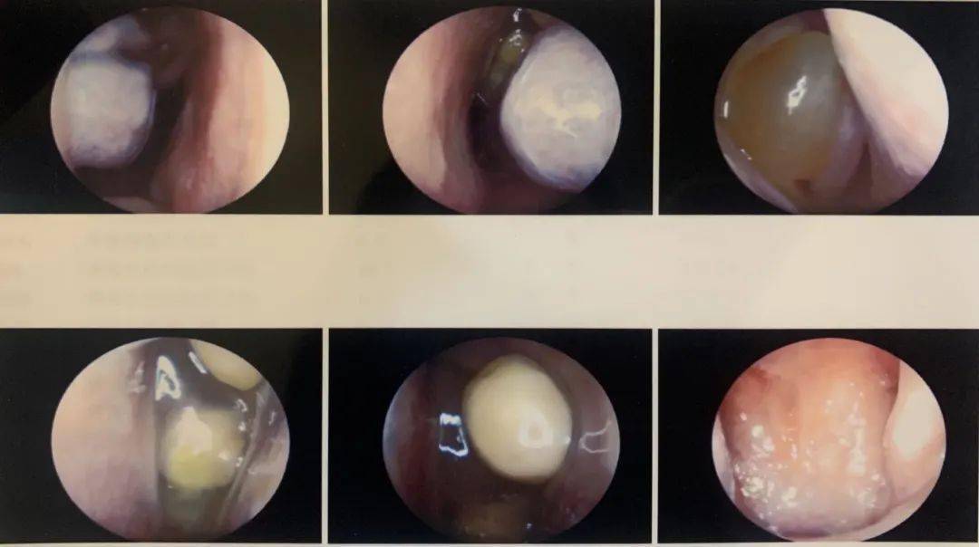 47岁养生专家鼻息肉术后复发莫虚鼻窦轮廓化药物支架再记一功
