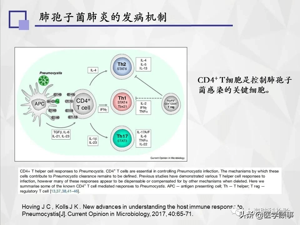 肺孢子菌病的临床特点,实验室检测,治疗及预防