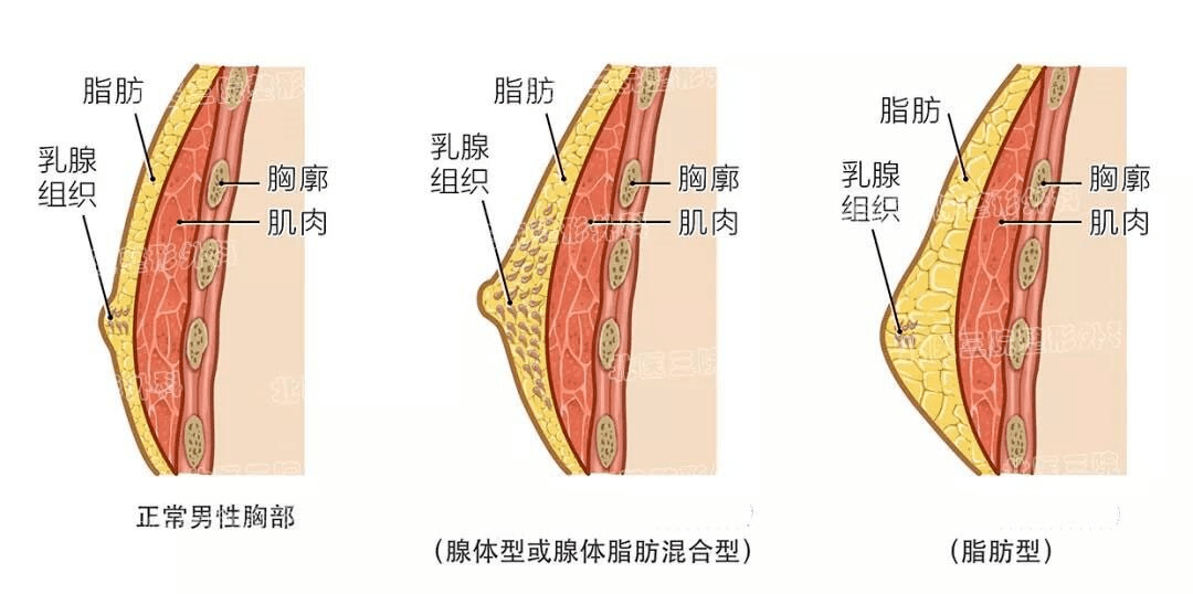 男人也会得乳腺癌!假如有这种情况,发病率特别高!_男性