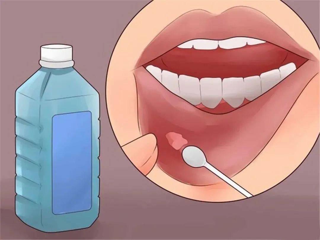 反复口腔溃疡一查竟是舌癌晚期!出现这4种症状别大意!