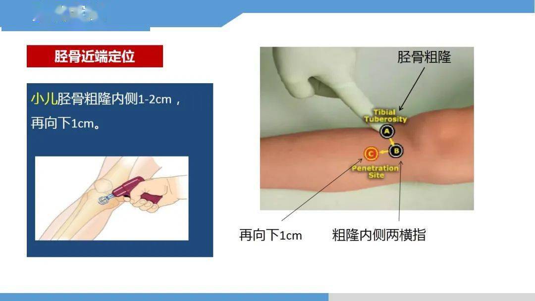 【ppt】永不塌陷的生命通路——骨髓腔输液技术