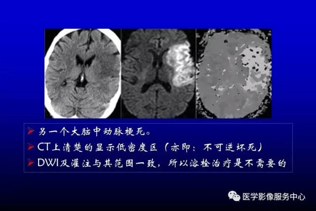 急性脑梗死的影像学表现