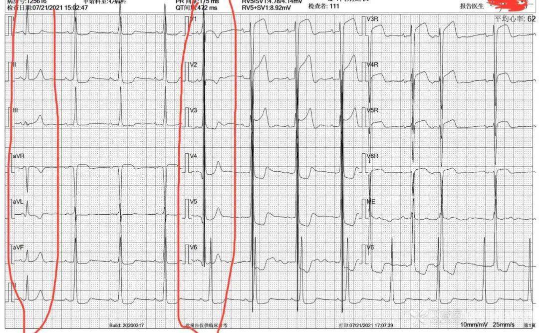 8 个预激综合征心电图,看完对「旁道迷路」不再困惑