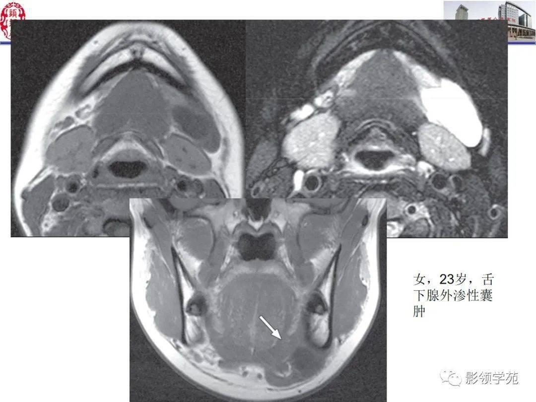 舌口底影像解剖及常见疾病影像诊断