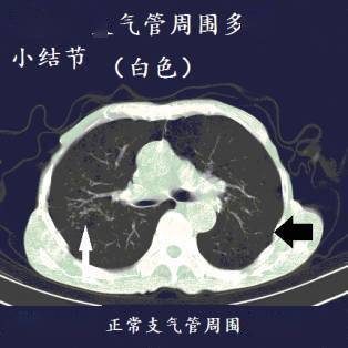 十二个病人的肺ct图像详细解读!_结核