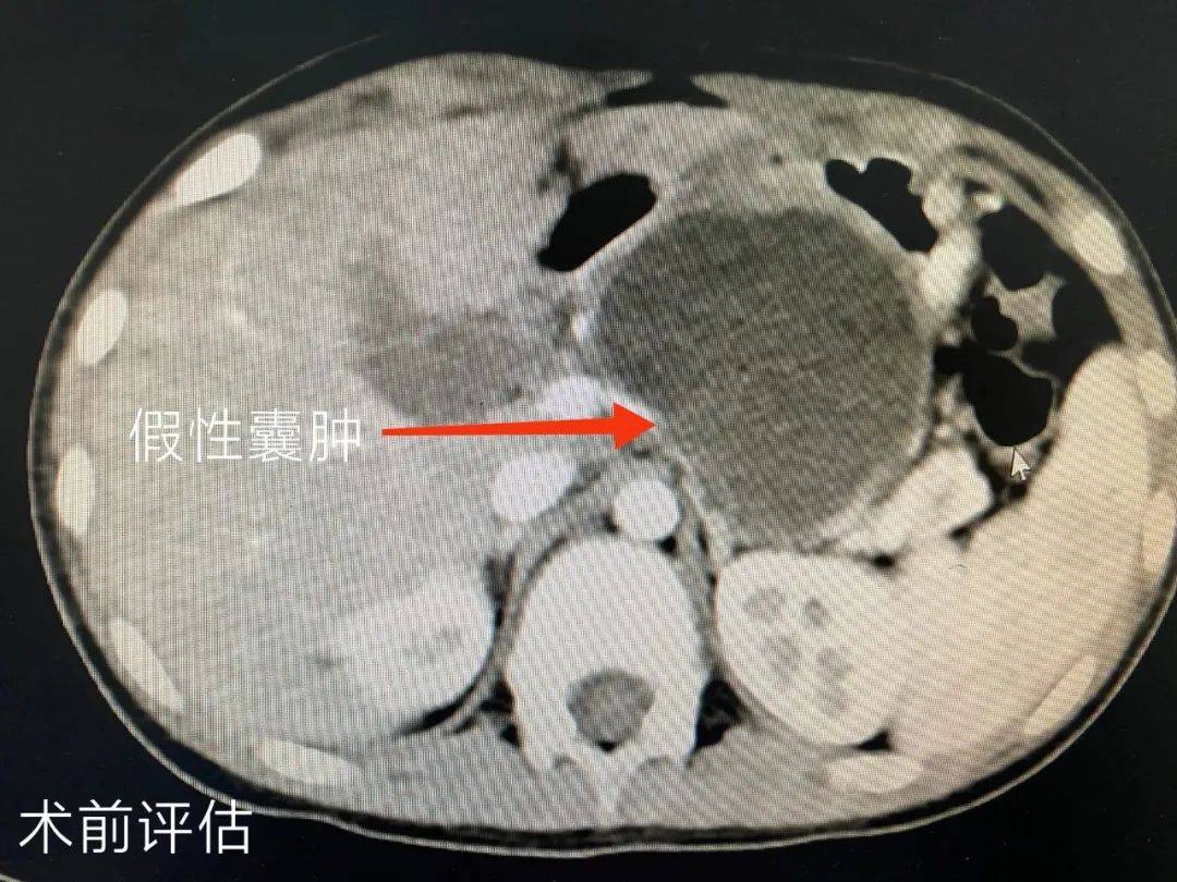 我院完成全腹腔镜下胰腺假性囊肿内引流术_手术