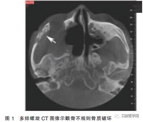 螺旋ct显示:右侧上颌骨缺失,右侧颧骨颧弓不规则骨质破坏,边界不清.