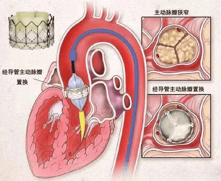 介入手术:通过大腿的血管置入完好的心脏瓣膜,成为崭新的"心门,无需